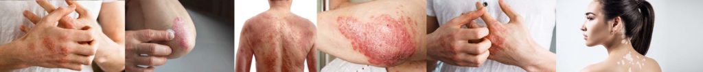 eczema symptoms causes types treatment