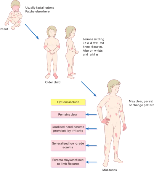 top 5 things about eczema