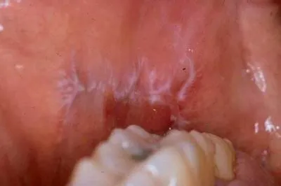 Lichen Planus Oral