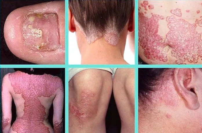 Psoriasis Treatment