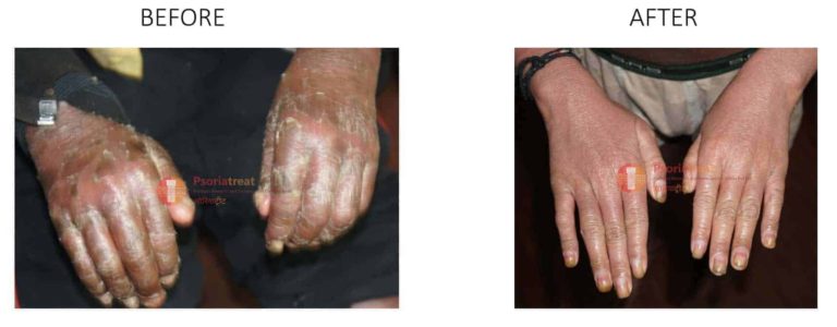 psoriasis arthritis treatments