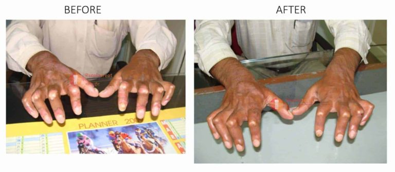 psoriasis arthritis treatment