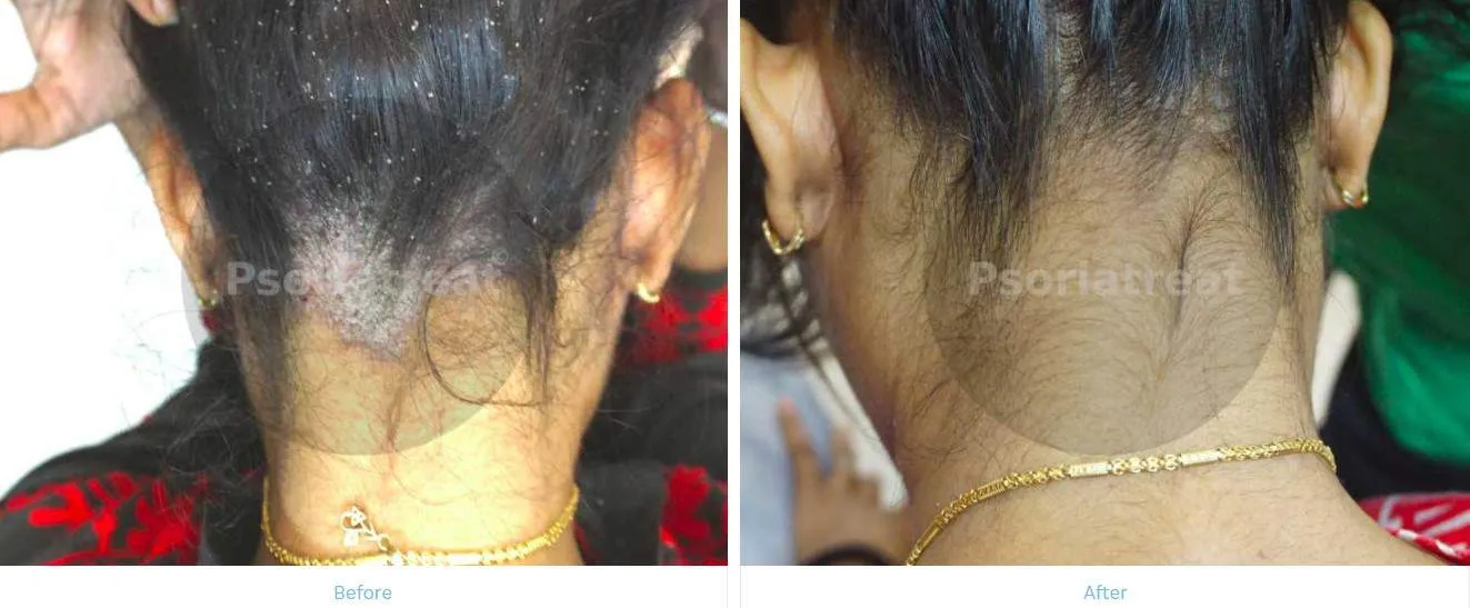 Scalp Psoriasis Treatment