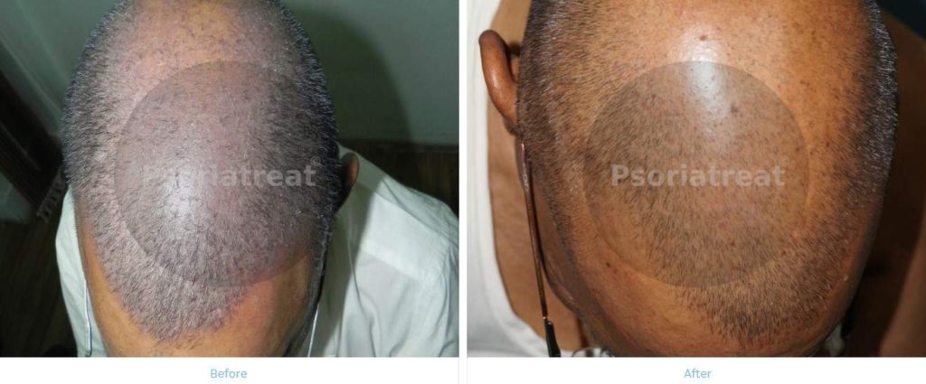 What Causes Scalp Psoriasis