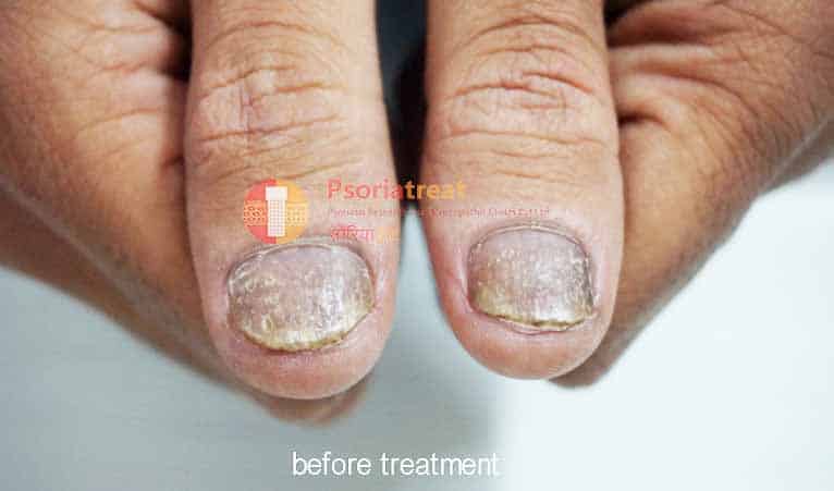 Nail Psoriasis Treatment