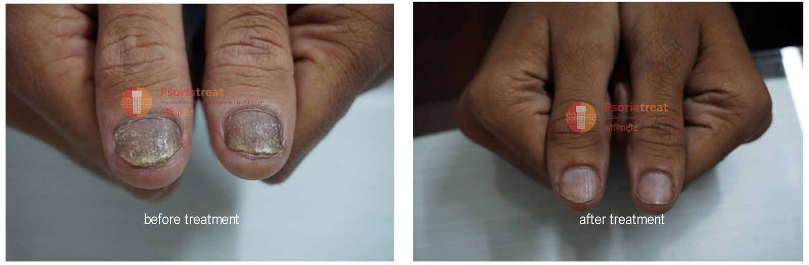 Nail manifestations affected the nail bed in nail psoriasis. a... |  Download Scientific Diagram