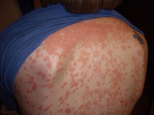 guttate psoriasis