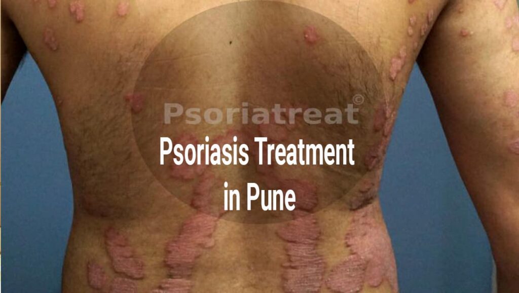 psoriasis treatment in pune