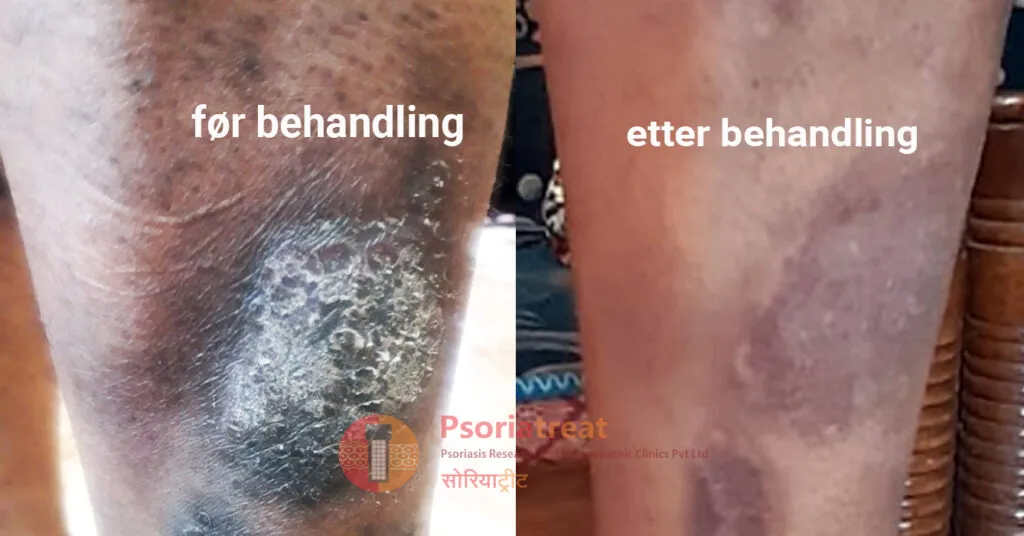 Behandling av Psoriasis og Lichen Planus med Homeopati