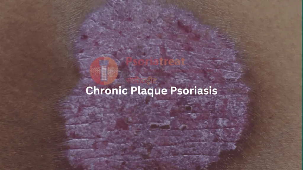 Successful Treatment of Psoriasis and Lichen Planus: A Case Study by Dr ...