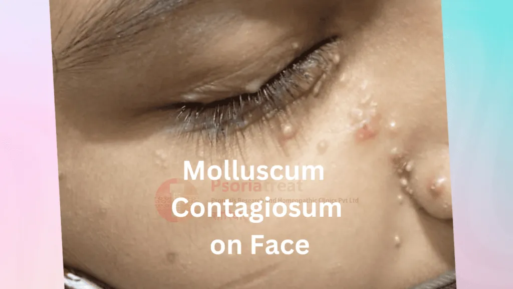 molluscum contagiosum on face