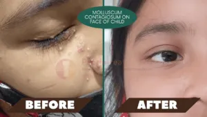 molluscum contagiosum on face of child