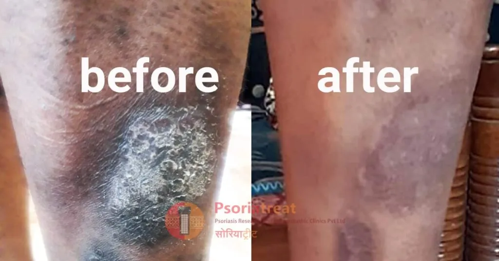 psoriasis patient case study