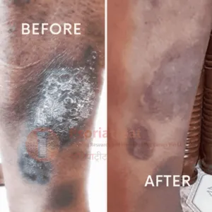 psoriasis patient case study