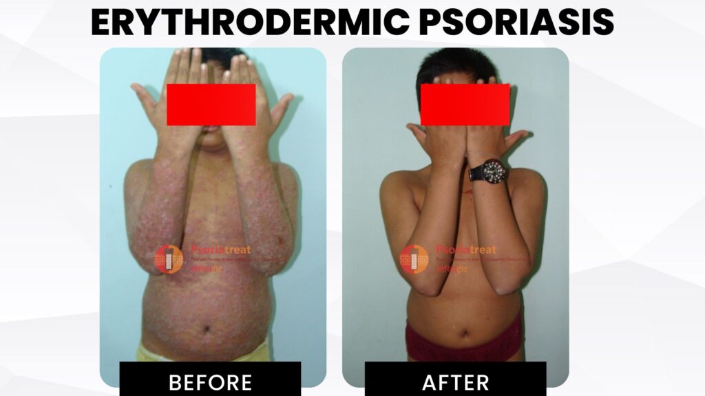 erythrodermic psoriasis treatment