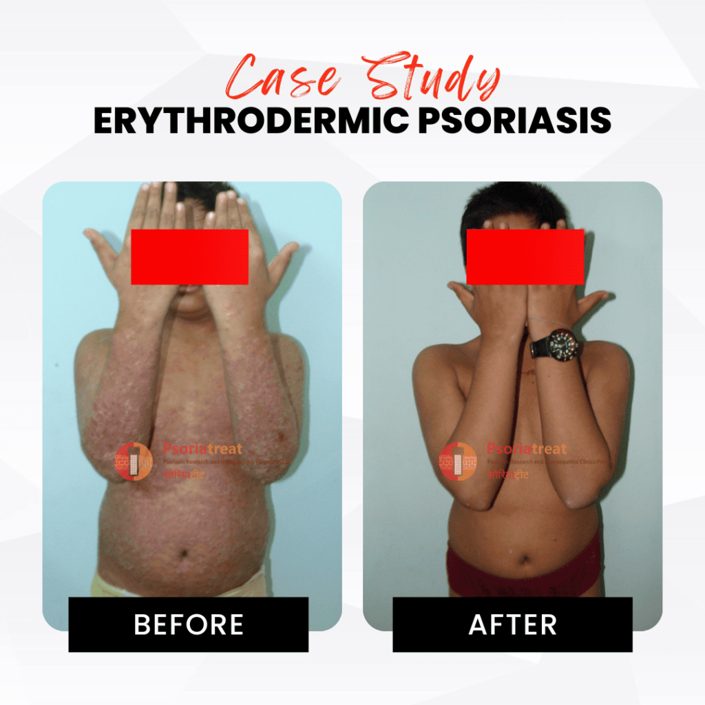 erythrodermic psoriasis treatment