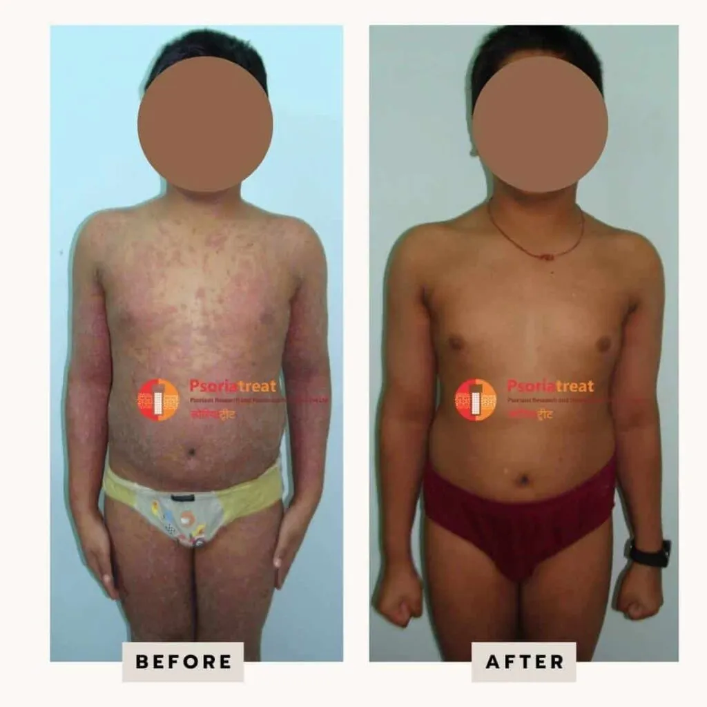 erythrodermic psoriasis treatment