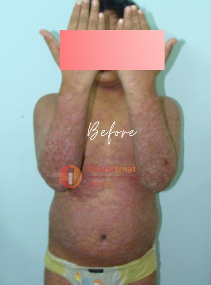 erythrodermic psoriasis treatment