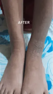 how to treat atopic dermatitis on feet