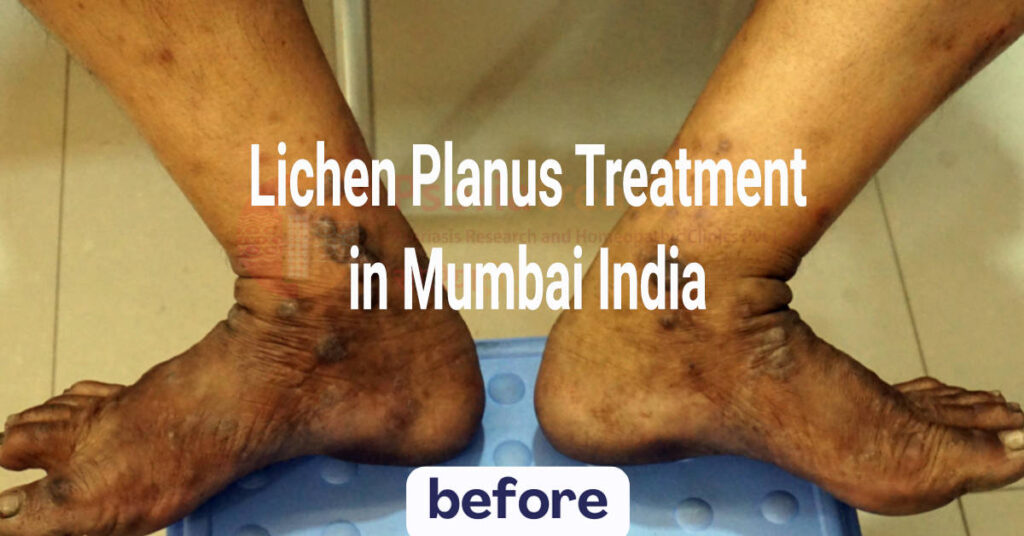 lichen planus treatment in Mumbai India