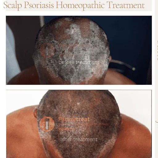 scalp psoriasis treatment in india