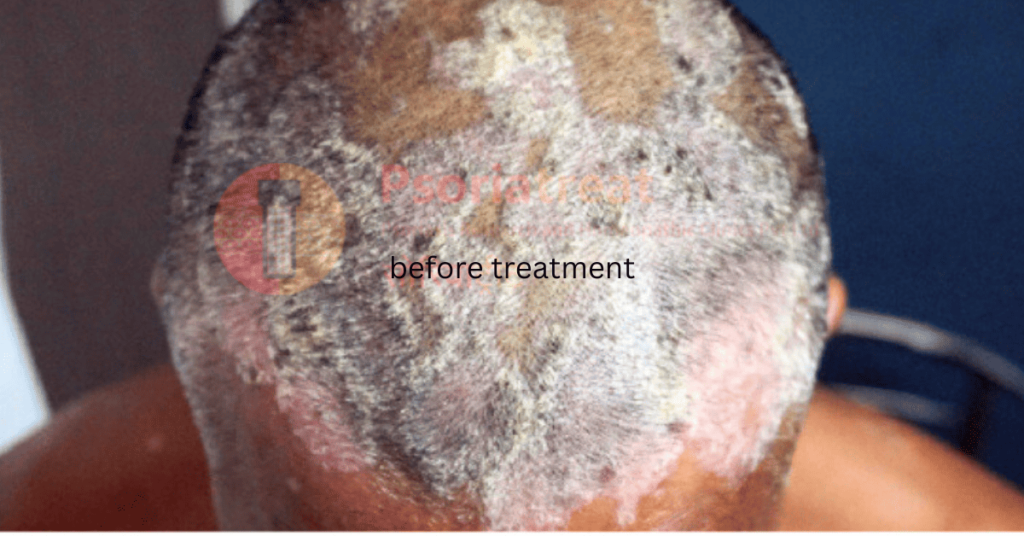 scalp psoriasis treatment in pune