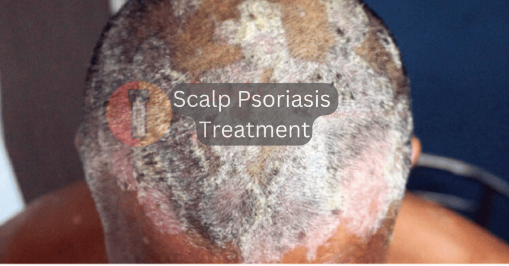 scalp psoriasis treatment in pune india doctor