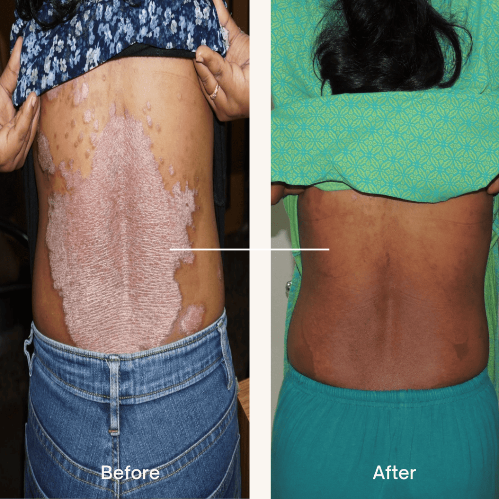 before after photo of a psoriasis patient treated successfully using homeopathy treatment