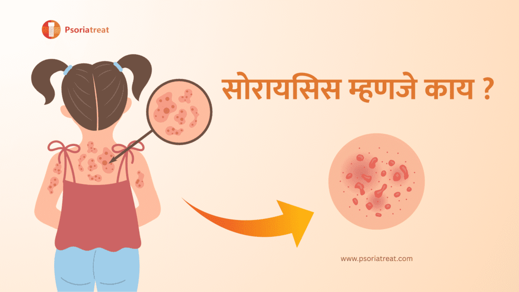 सोरायसिस शरीराच्या एका भागातून दुसऱ्या भागावर पसरू शकतो का? - Can psoriasis spread from one body part to another? in marathi 2 What is psoriasis in marathi