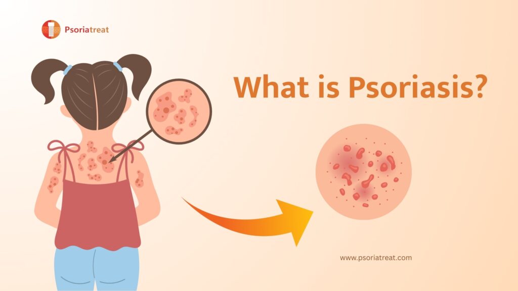 What is psoriasis?