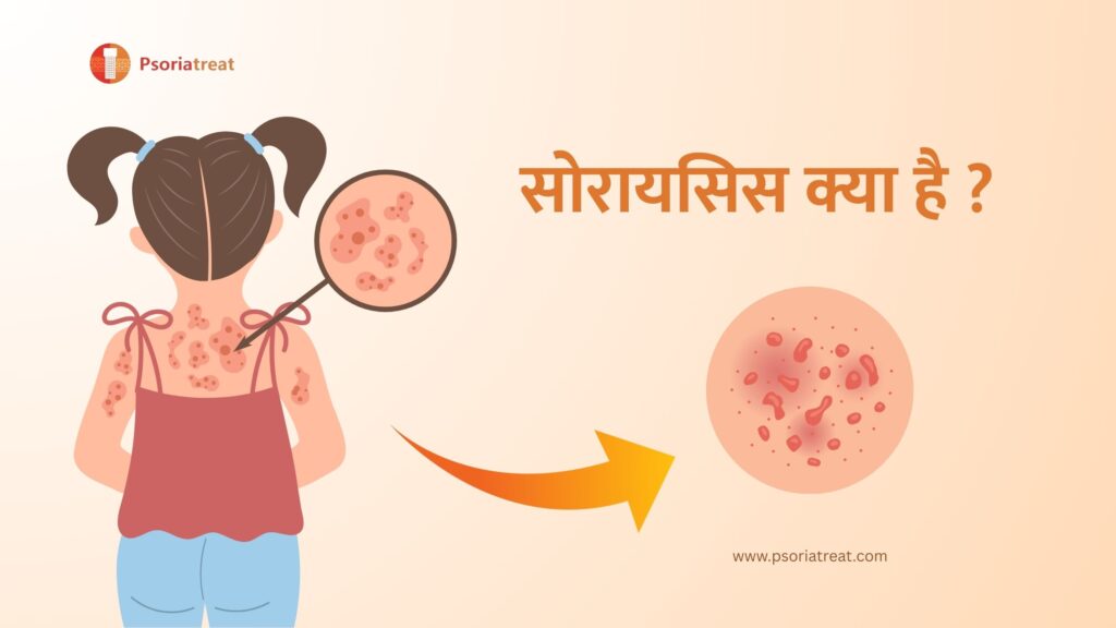 क्या सोरायसिस शरीर के एक हिस्से से दूसरे हिस्से में फैल सकता है? - Can psoriasis spread from one body part to another? in hindi 2 Hindi Blogs