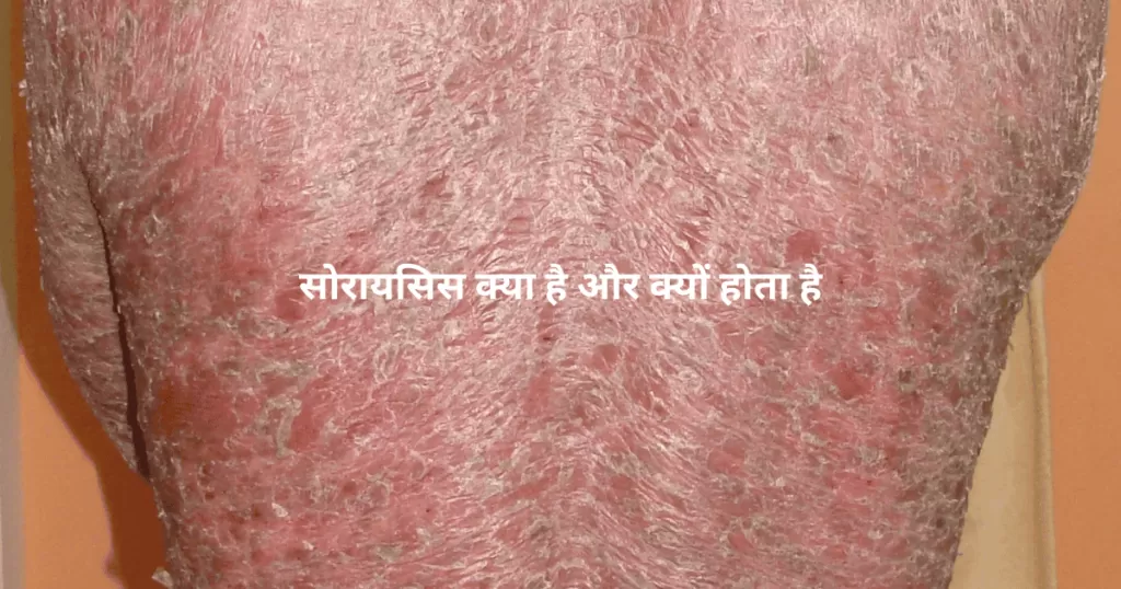 सोरायसिस क्या है और क्यों होता है