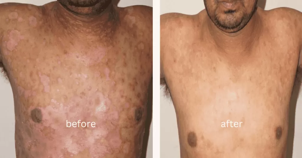 psoriasis treatment