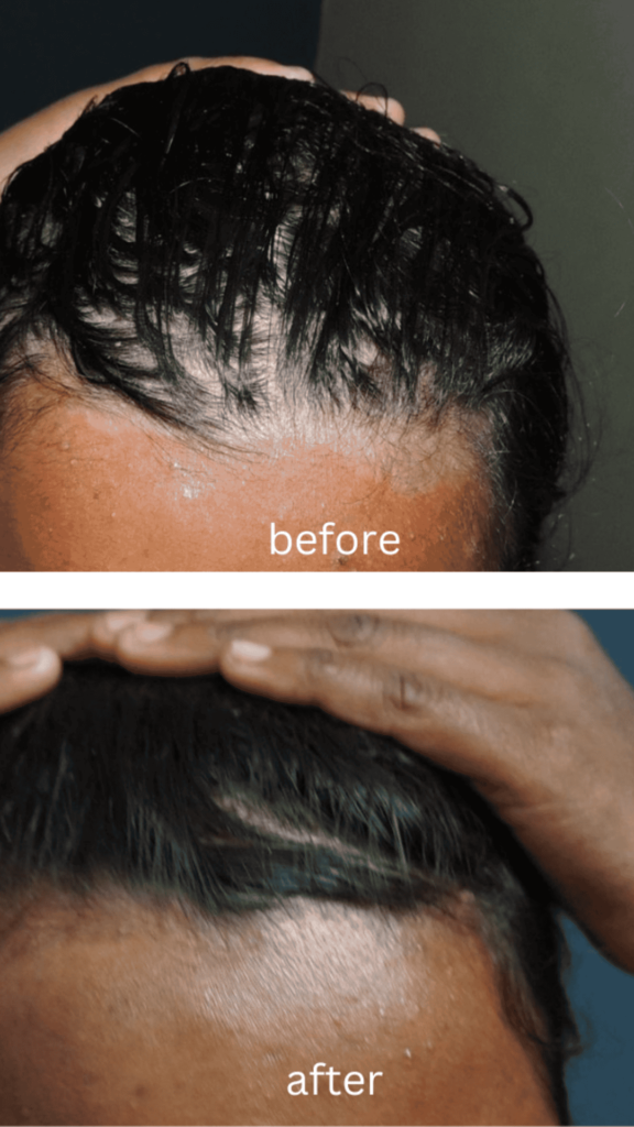 psoriasis treatment of scalp