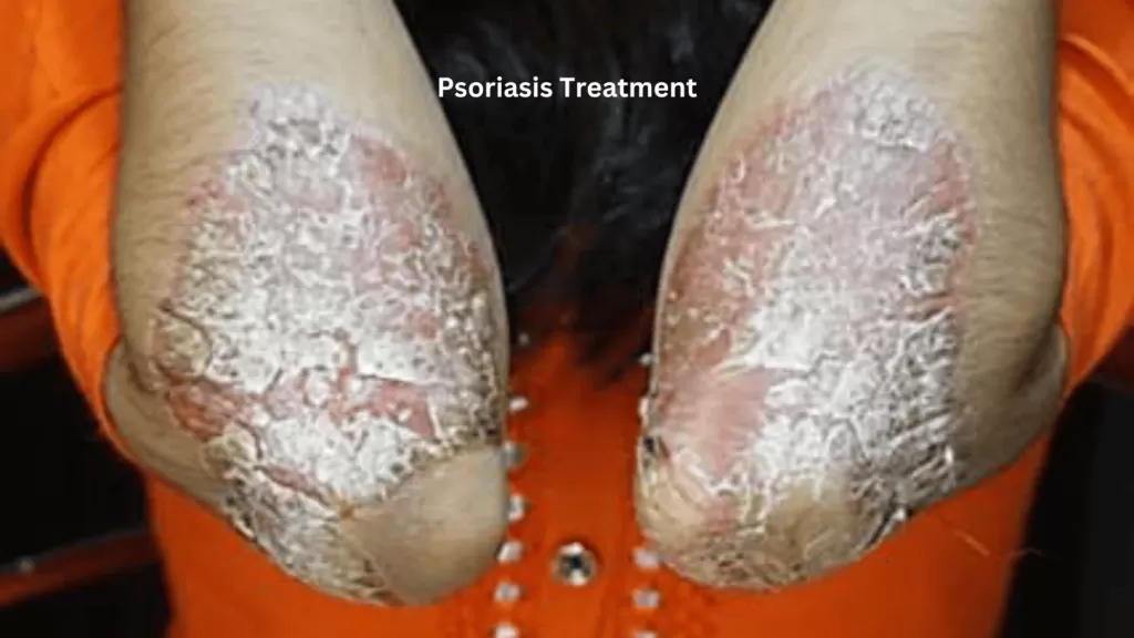 psoriasis treatment