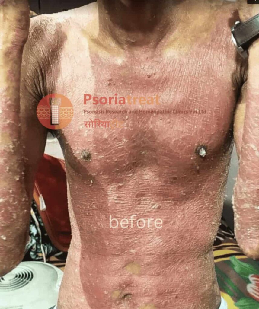 severe psoriasis patient