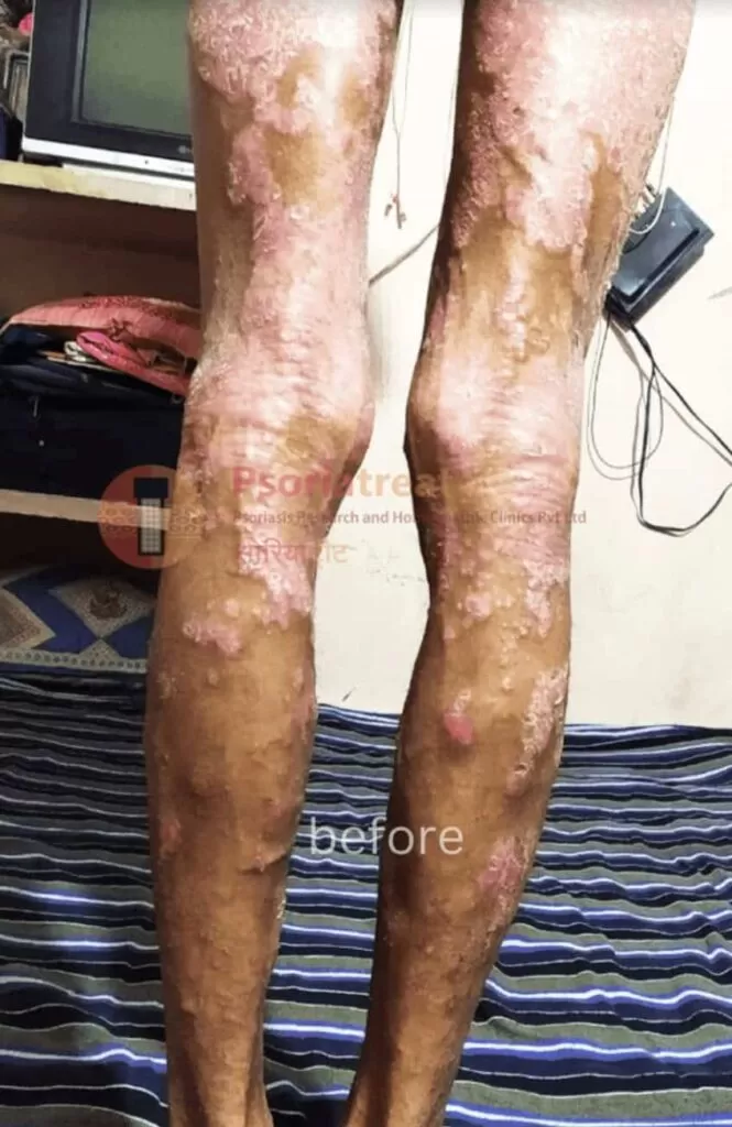 severe psoriasis treatment