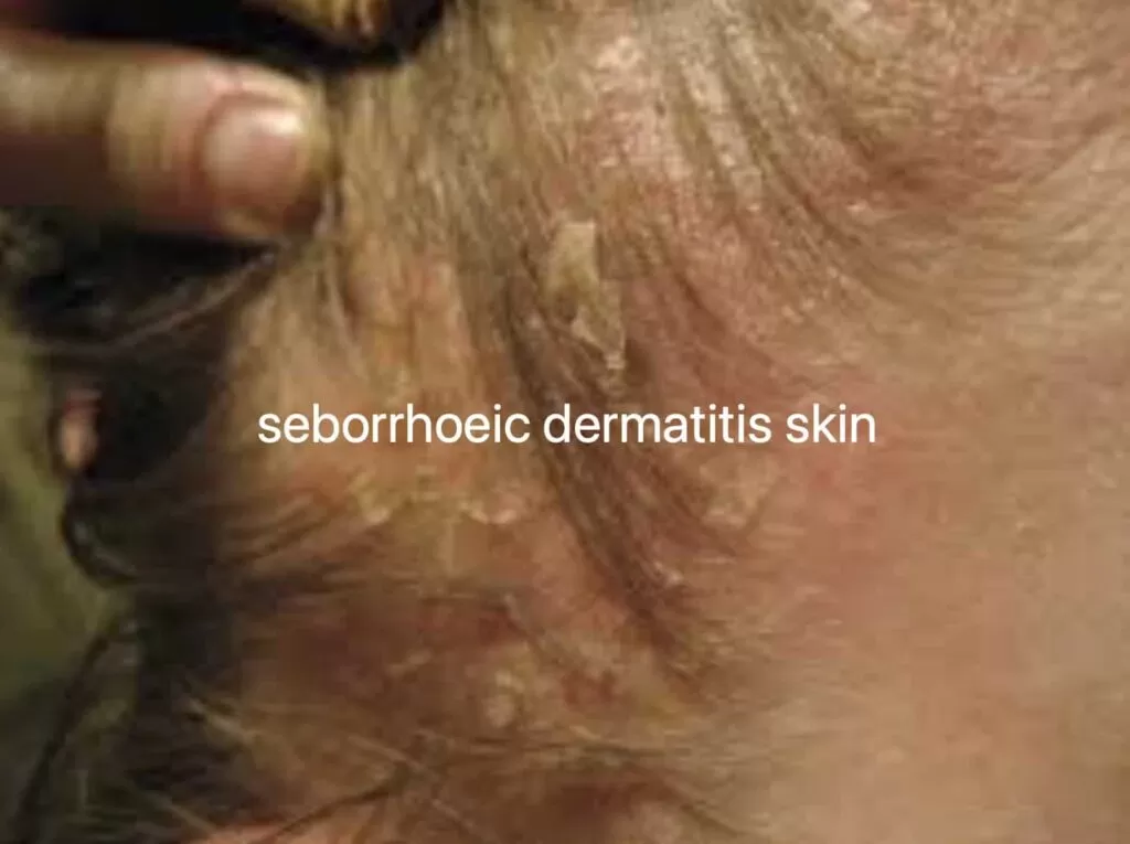 seborrhoeic dermatitis skin