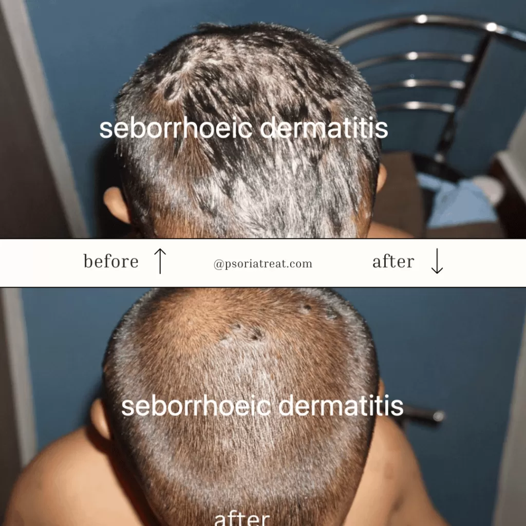 seborrhoeic dermatitis treatment at home