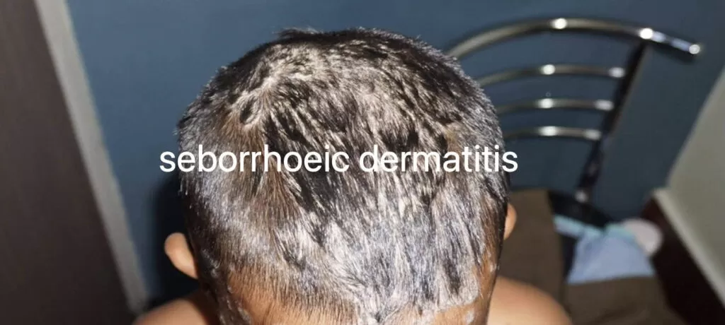 seborrhoeic dermatitis treatment at home