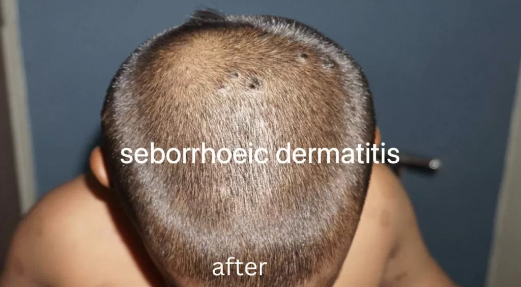 seborrhoeic dermatitis treatment at home