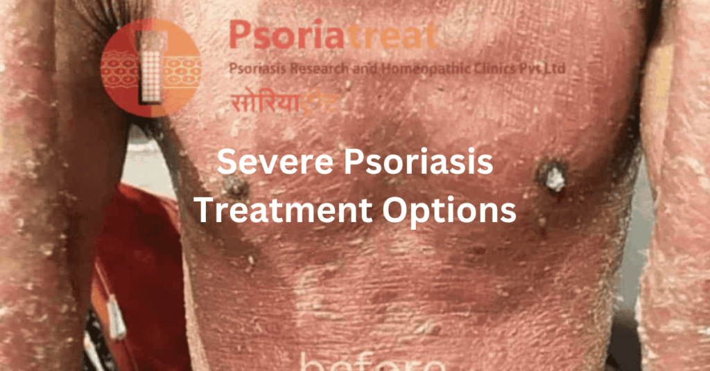 severe psoriasis treatment options