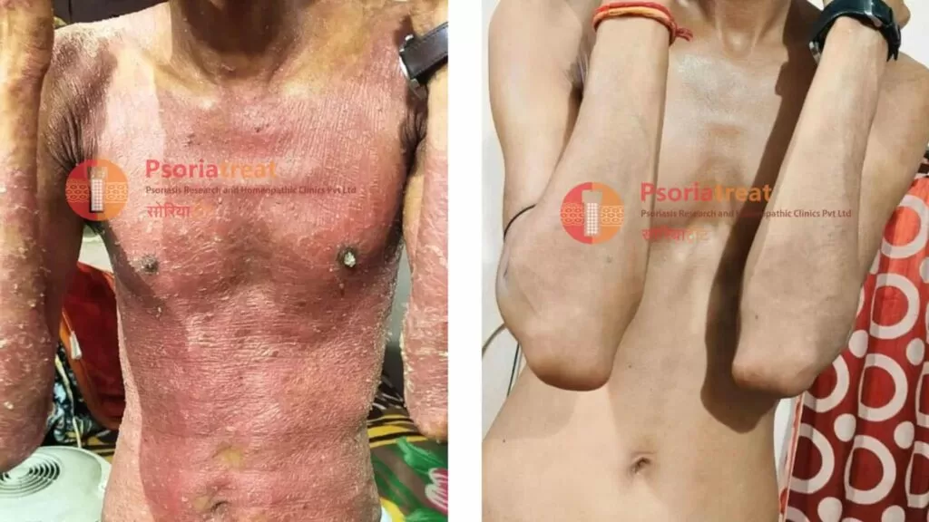 severe psoriasis treatment options