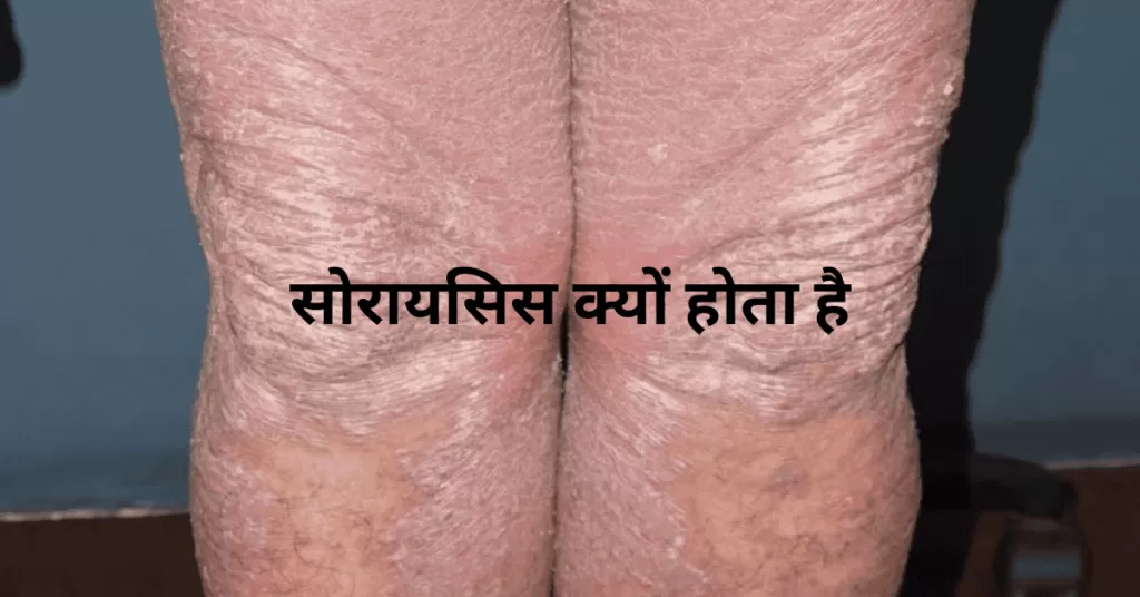 सोरायसिस क्यों होता है