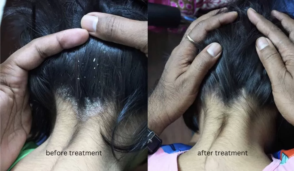 before treatment and after treatment of a scalp psoriasis