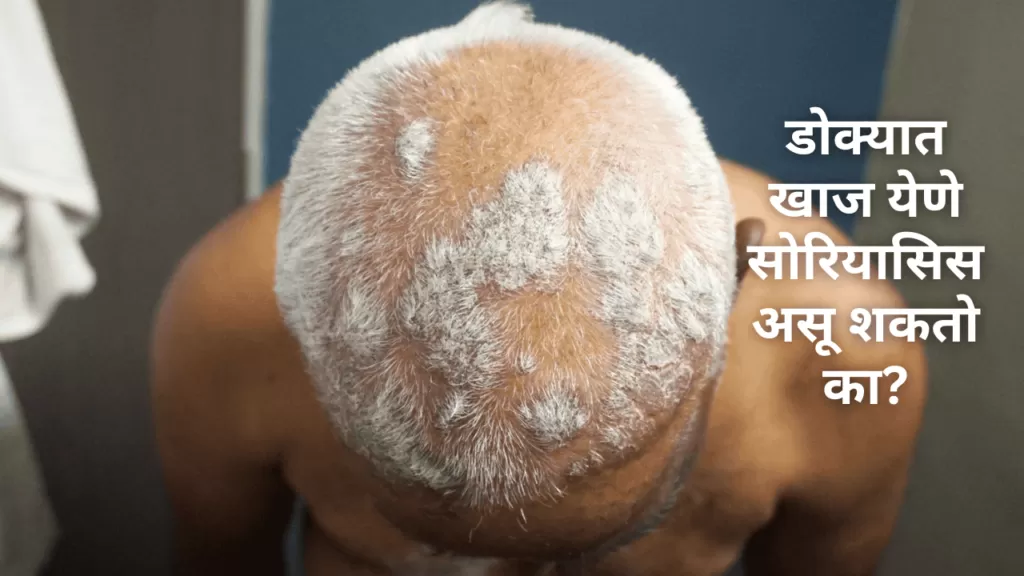 डोक्यात खाज येणे सोरियासिस असू शकतो का