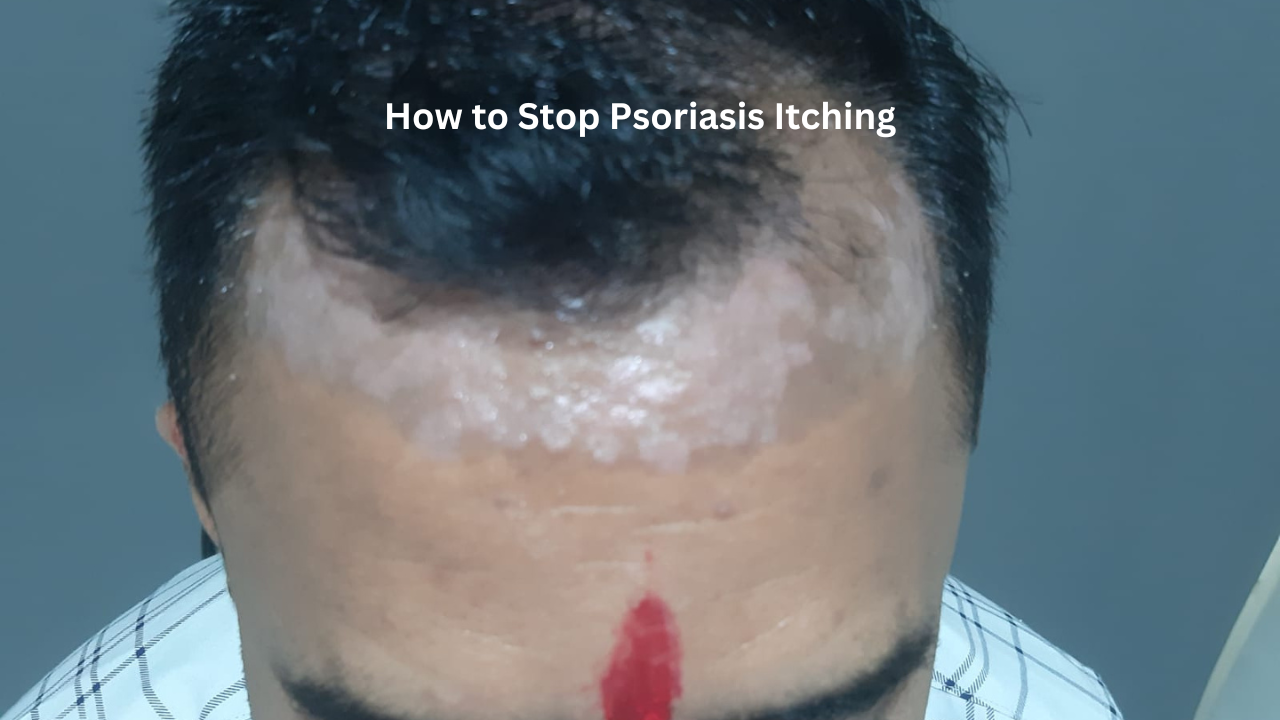 Effective Ways To Stop Psoriasis Itching At Night And On The Scalp Expert Tips By Dr Rajendra