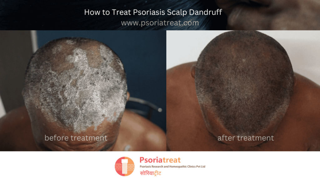 Psoriasis Scalp Flakes Removal