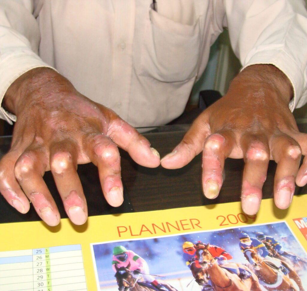 Psoriatic Arthritis - Symptoms, Treatment, Diagnosis 2