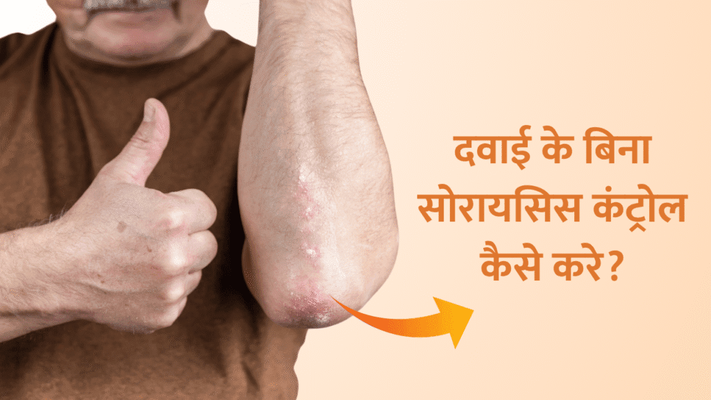 दवाई के बिना सोरायसिस कंट्रोल कैसे करे? How to control Psoriasis without Medicine in Hindi? 1 How to control Psoriasis without Medicine in Hindi?